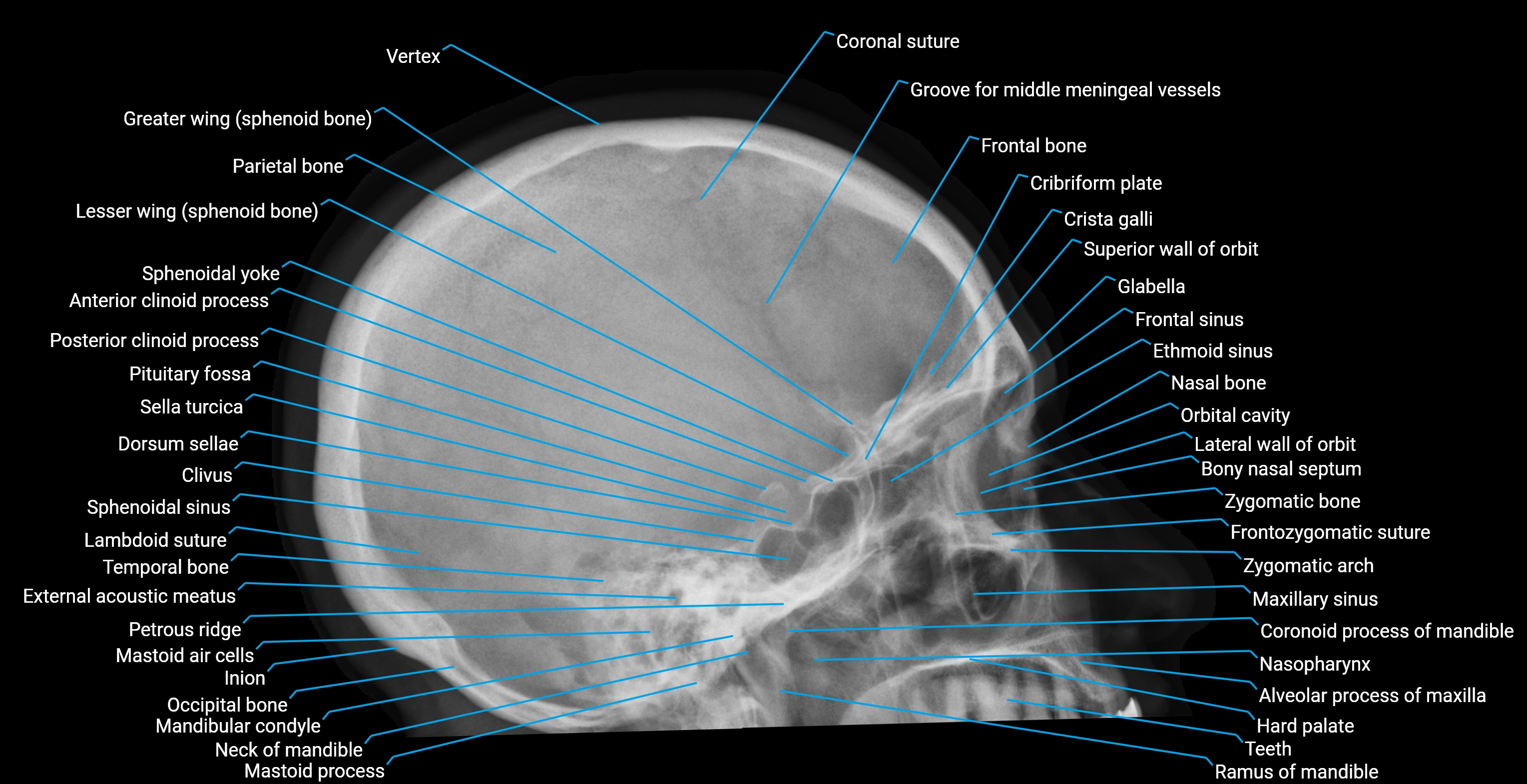 x ray  skull lateral labelled anatomy image.webp